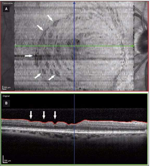 Figure 2. Aspect de dissociation de la couche des fibres optiques (DONFL) 6 mois après une chirurgie de trou maculaire avec pelage de membrane limitante interne, bien visible (flèches blanches) sur l’OCT en face (A) et en coupe horizontale (B).
