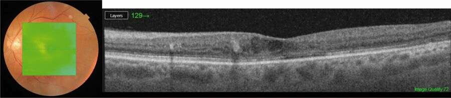Figure 4. OCT maculaire à 3 mois postinjection d’un troisième implant de dexaméthasone et 1 mois postopératoire d’une chirurgie de la cataracte, retrouvant une amélioration du profil maculaire et une diminution du fluide intrarétinien résiduel.

