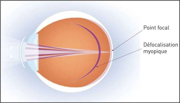 Figure 1. Les lentilles “dual focus” dessinées pour induire du défocus myopique
