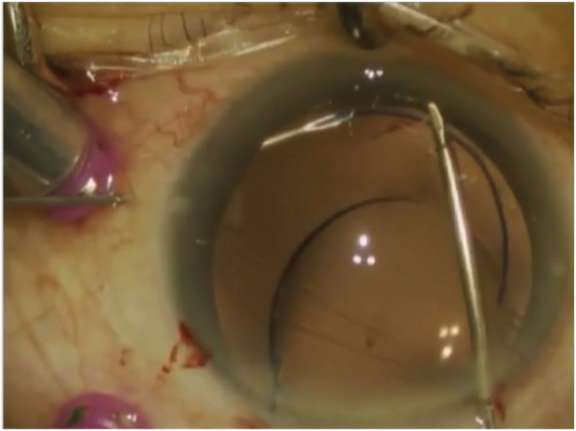 Figure 4. Flanged IOL technique, récupération de l’haptique d’un implant 3 pièces à l’aide d’une aiguille 30 G après passage transscléral (image extraite de la vidéo du Pr Malyugin).
