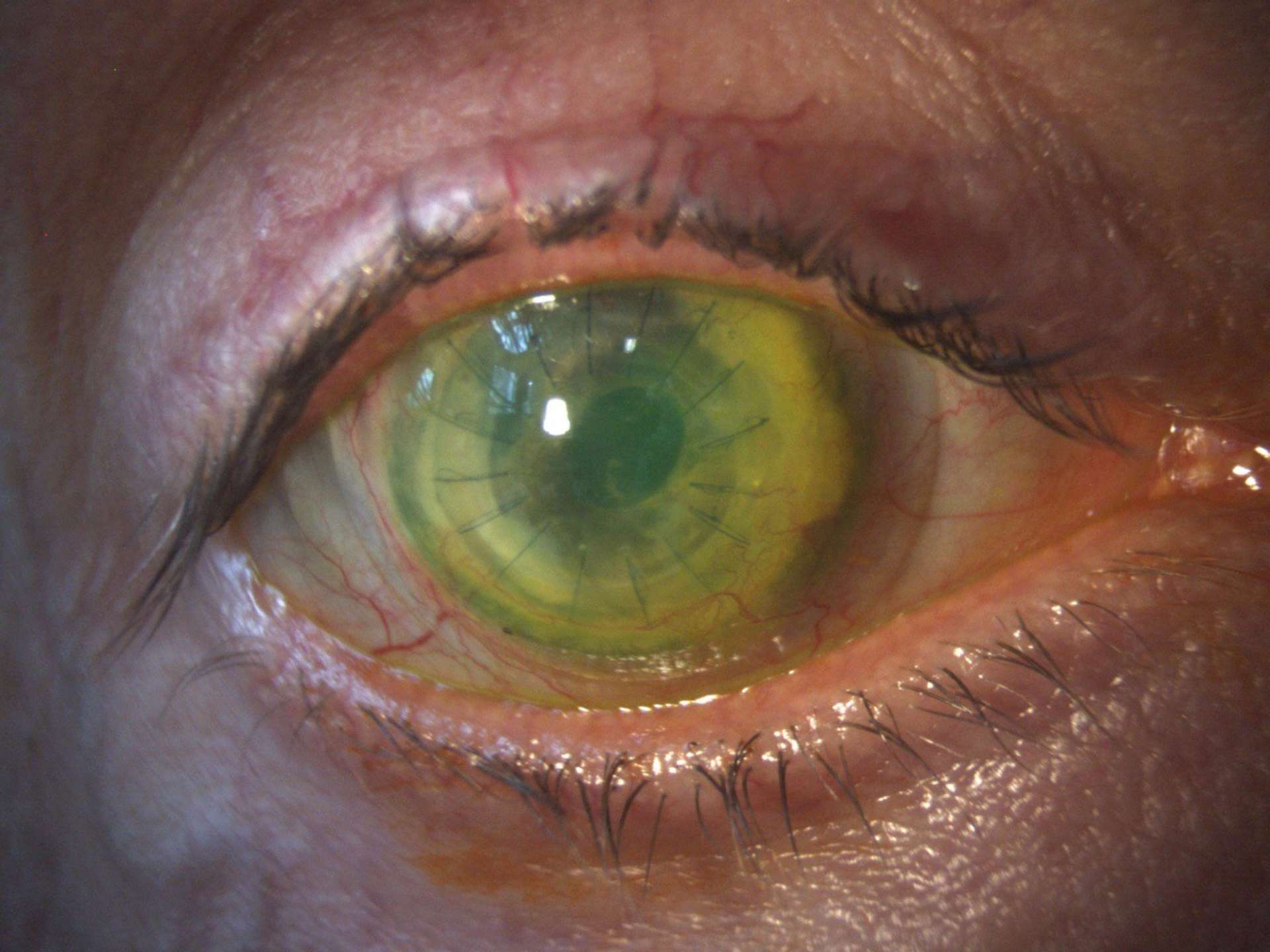 Figure 3. Lentille sclérale (ICD diamètre 16,50 mm, LCS) chez un patient avec des ulcérations récidivantes compliquées d’une perforation sur une greffe de cornée. La lentille sclérale améliore son confort de vie et évite les ulcérations. 
