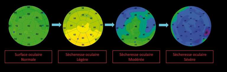 Figure 8. Proposition d’une classification de la sévérité de la sécheresse oculaire selon 4 types de topographies présentant des distributions de l’épithélium cornéen différentes en fonction du degré d’atteinte.

