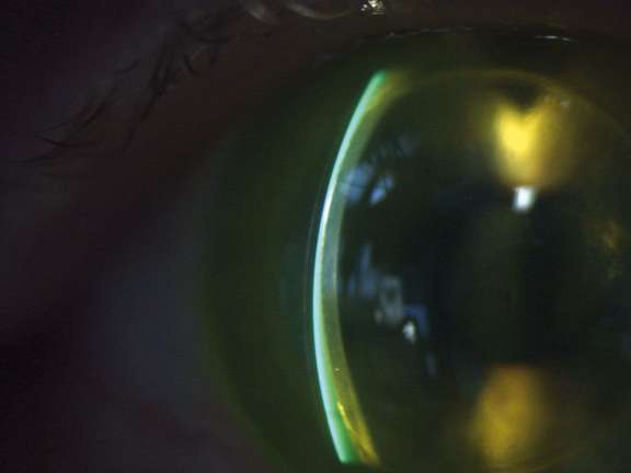 Figure 1B. Même patient avec la même lentille en fente fine à 45° montrant l’espace liquidien entre la face postérieure de la lentille et la greffe.

