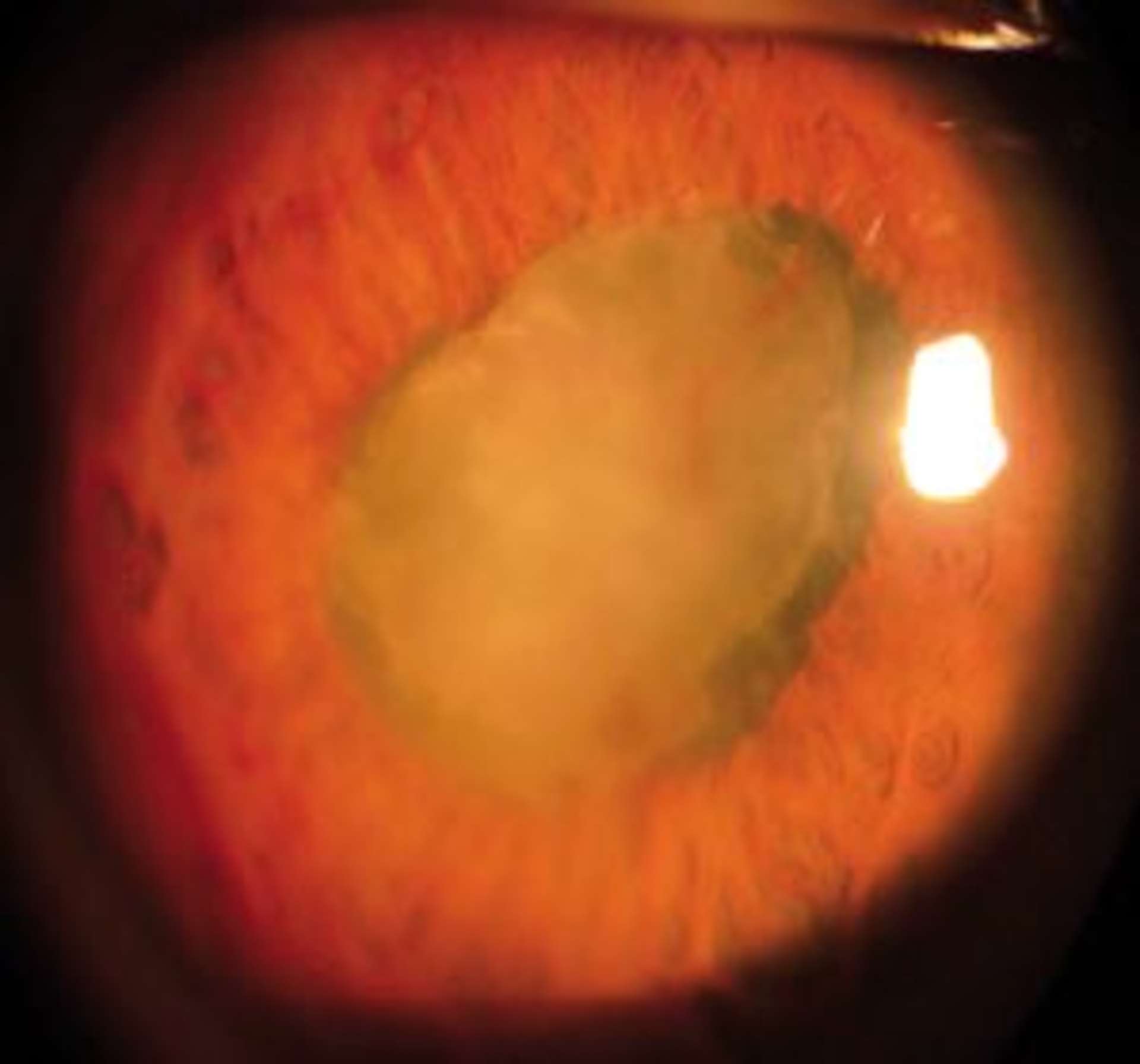 Figure 1. Risque élevé de séclusion pupillaire chez un patient présentant une uvéite sarcoïdosique : la prévention repose sur le contrôle de l’inflammation pour éviter la formation de synéchies iridocristal­liniennes sur 360 °. 
