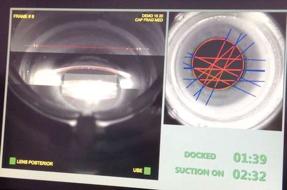 Imagerie par caméra rotative avec interface patient en immersion. Détection automatisée sur chaque coupe de la cornée et du cristallin.
