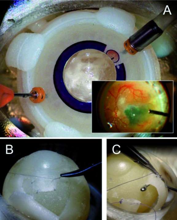 Figure 4. Exemples d’outils de simulation du kit Bioniko sur œil artificiel. A. Pelage de membrane. B. Suture d’un volet scléral. C. Chirurgie des muscles oculomoteurs.

