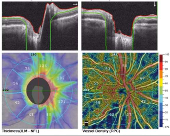 Figure 1. Analyse par OCT-A du flux péri­papillaire super­ficiel complété par les cartographies d’épaisseur de fibres RNF.
