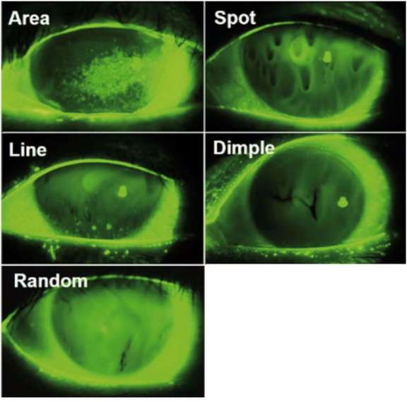 Figure 2. Différents patterns de rupture du film lacrymal.
