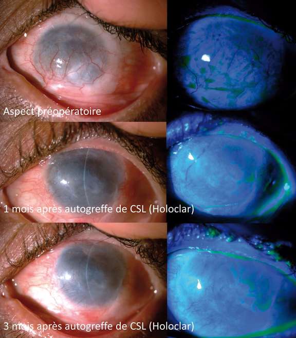 Figure 3. Aspect pré- et postopératoire d’un œil présentant une insuffisance limbique complète secondaire à une brûlure sévère et traité par une autogreffe de cellules souches limbiques cultivées. On constate une disparition des néovaisseaux cornéens superficiels, une régularisation de l’épithélium cornéen, une disparition de l’hyperperméabilité épithéliale et une régression des symptômes. Du fait de l’opacification du stroma cornéen, une greffe de cornée sera nécessaire dans un deuxième temps pour améliorer l’acuité visuelle.

