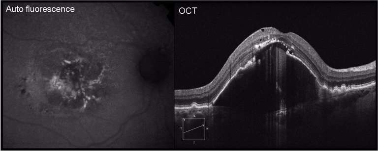 Figure 2C. Neuf mois après le diagnostic initial, on observe une modification à la surface du soulèvement, notée sur le cliché en autofluorescence (à gauche). La coupe d’OCT-B objective une déchirure de l’EP sans rétraction, ce qui confirme le caractère avasculaire du soulèvement.
