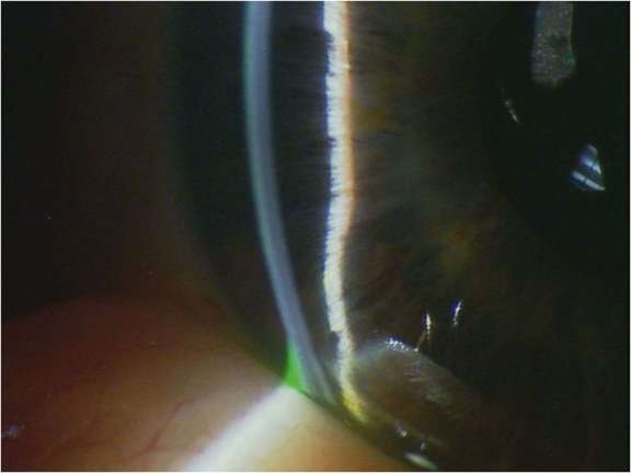 Figure 1. Présence d’une voussure irienne faisant suspecter une cause secondaire de fermeture angulaire.
