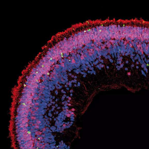 La mort cellulaire (en vert) est observée dans une coupe transversale d’organoïde de rétine exposé aux déoxysphingolipides. Les photorécepteurs apparaissent en rouge, les noyaux en bleu.&nbsp;© Lowy Medical Research Institute / Kevin Eade
