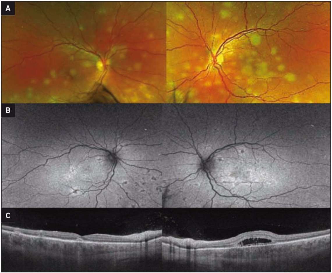 Figure 1. Imagerie multimodale au moment du diagnostic. A. Rétinophotographie ultra grand champ de l’œil droit et de l’œil gauche objectivant des plaques de couleur jaunâtre polycycliques. B. Clichés en autofluorescence en lumière bleue de l’œil droit et de l’œil gauche retrouvant des lésions hypoautofluorescentes à marges hyperautofluorescentes. C. Coupe OCT-B scan des 2 yeux mettant en évidence une disruption de la ligne ellipsoïde et de la zone d’interdigitation avec hyperréflectivités des couches externes de la rétine en regard. Il est noté la présence d’un espace hyporéflectif probablement œdémateux à l’œil gauche
